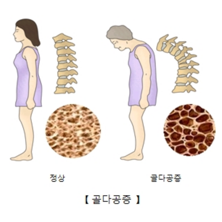 뼈건강-악화로-합병증이-발생한-중년-여성
