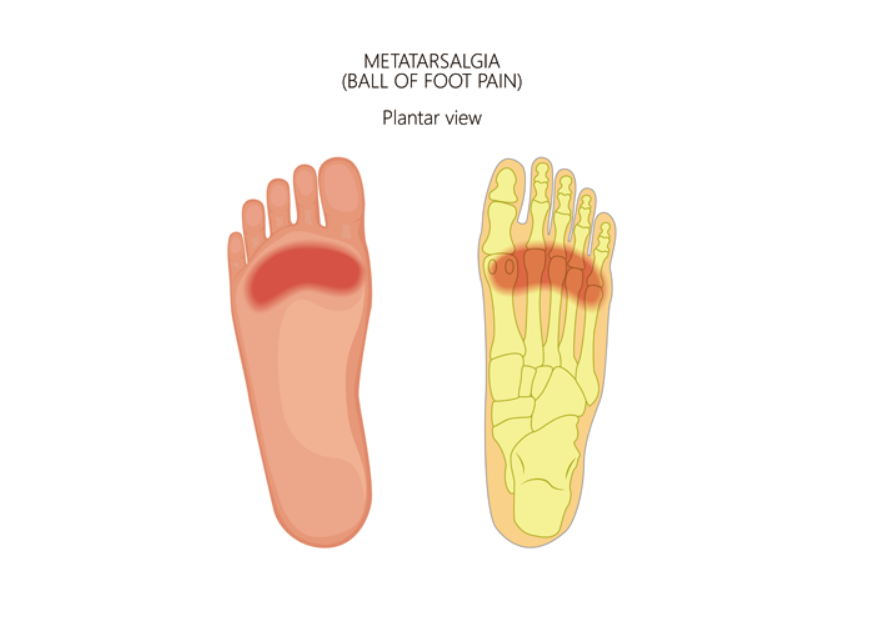 족저근막염 예방