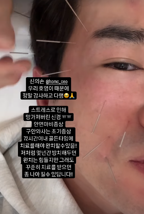 안면마비 침치료