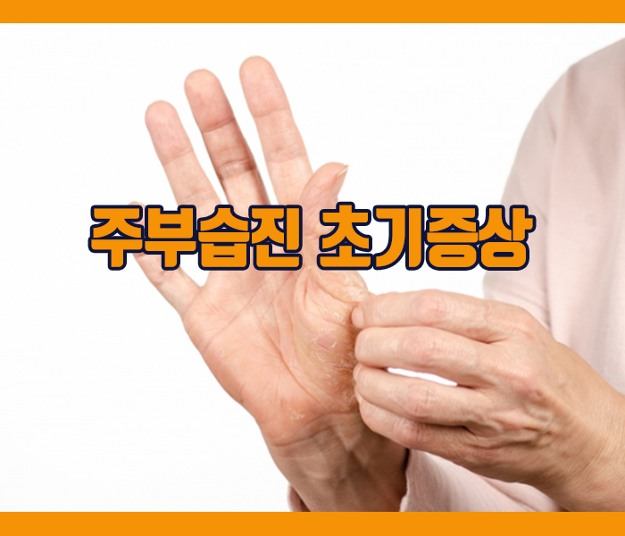 주부습진 초기증상 - 피부건조와 거칠어짐, 작은물집과 가려움증, 피부색변화, 피부갈라짐 등