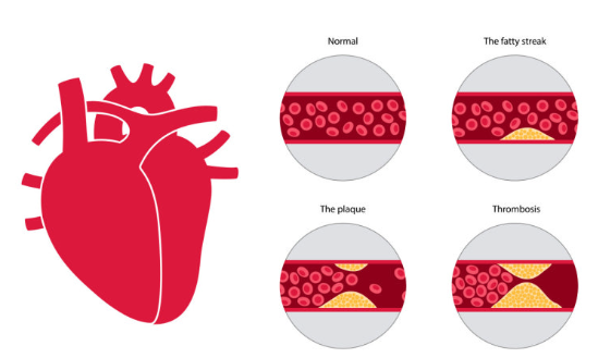 부정맥 조기 발견과 만성질환의 위험 관련 이미지