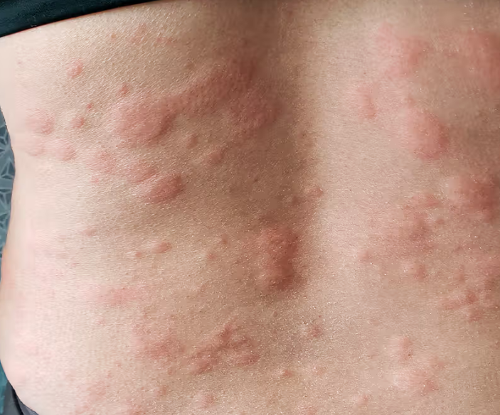 피부가려움증의 원인 2