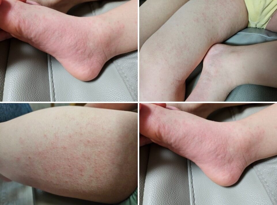 발과 주변 피부 발진 증상
