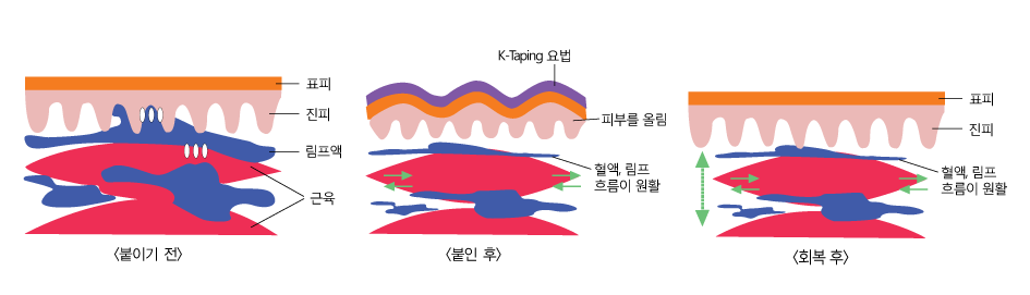 테이핑의 작용원리