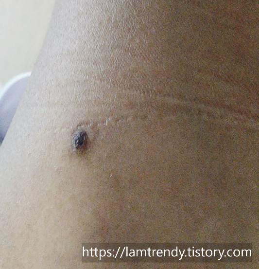 쥐젖 냉동치료후 한달