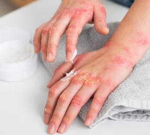 콜린성-두드러기-2