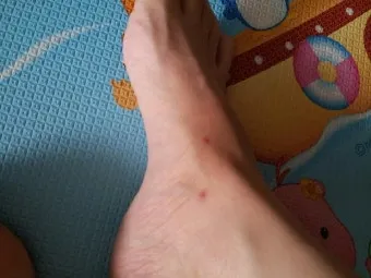 모기 물려 가려울 때 땀띠에 안티푸라민 연고 효능 부작용 사용후기_24
