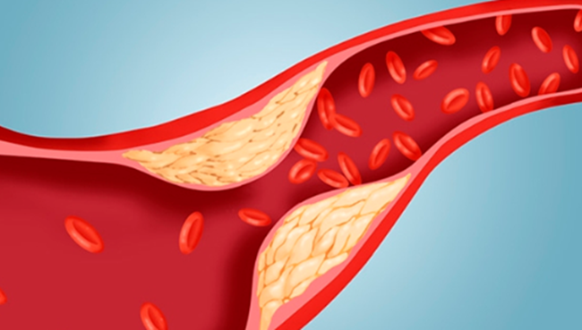 콜레스테롤 낮추는 방법