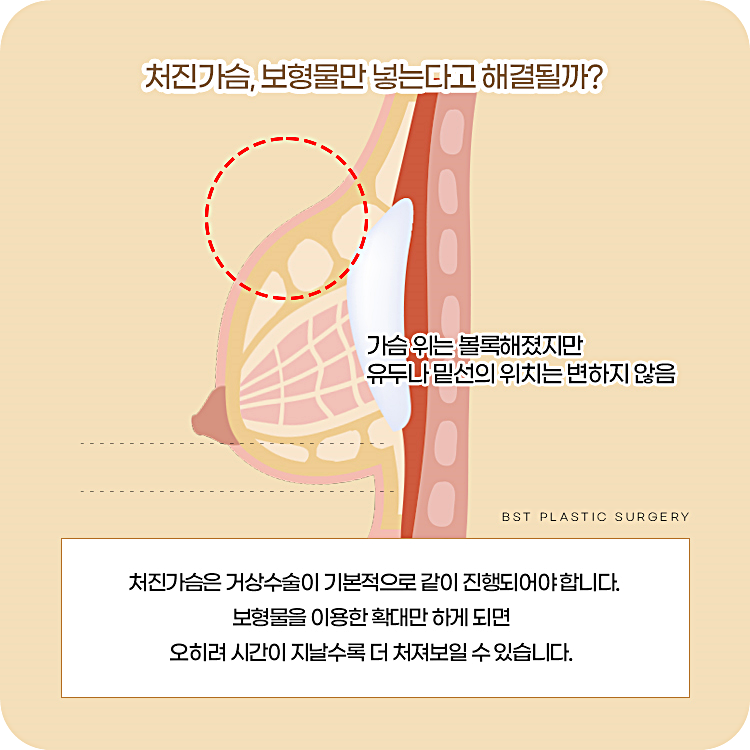 처진가슴, 보형물만 넣는다고 해결될까요? 처진가슴은 거상수술이 기본적으로 같이 진행되어야 합니다. 보형물을 이용한 확대만 하게 되면 오히려 시간이 지날수록 더 처져보일 수 있습니다.