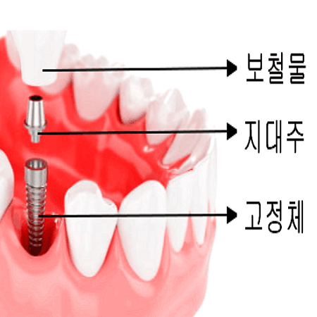 임플란트에 필요한 구성품들