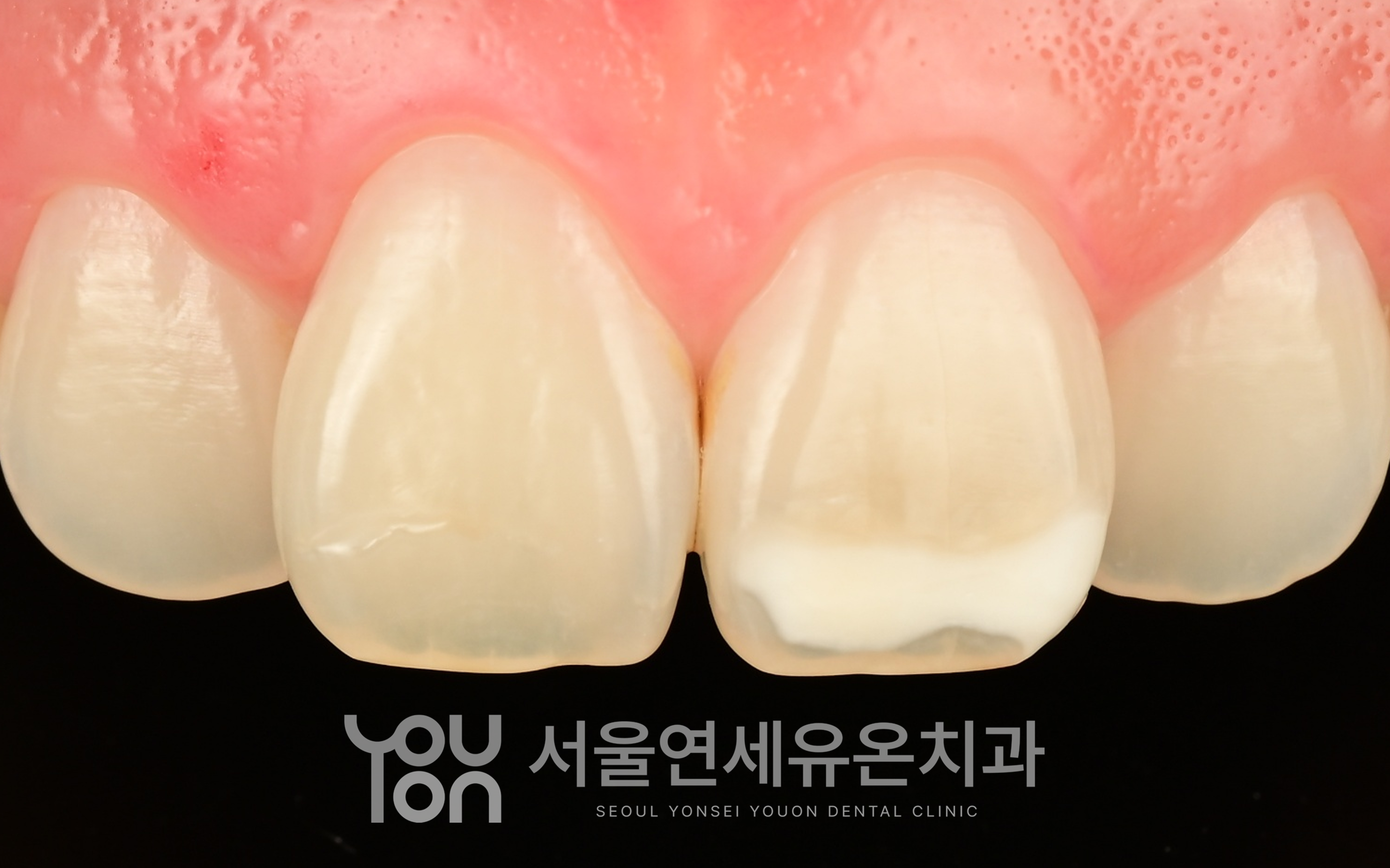 앞니에 하얀 반점(반점치)이 보이는 치료 전 상태