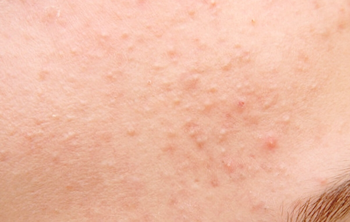 이마에 난 여드름