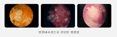 방광염의 약에 대한 효능과 주의할 점