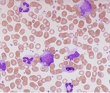 급성 백혈병의 FAB 분류 vs WHO 분류 비교 분석: 진단 체계의 진화와 임상적 의의