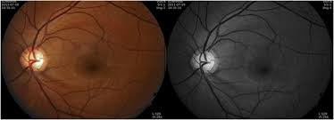 안압이 높을 때 증상