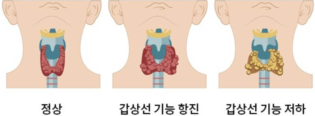갑상선 기능 저하증 비교 분석