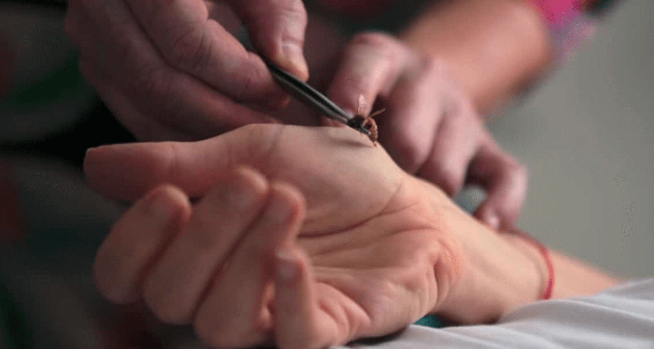 손가락 마디 통증 봉침