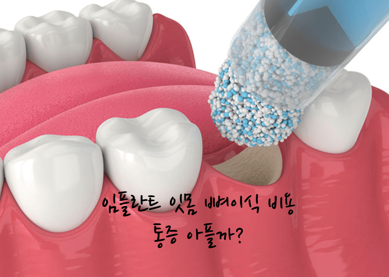 뼈이식 비용