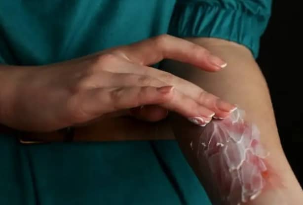 화상 연고 이미지