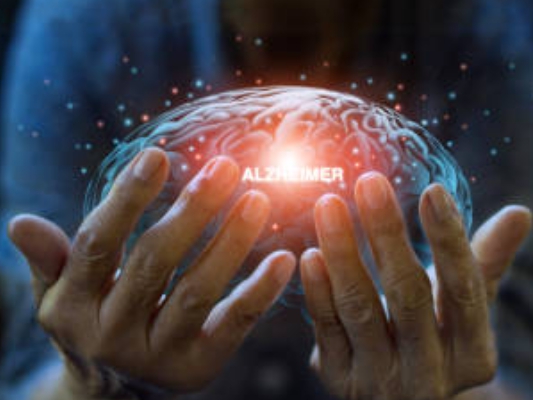 알츠하이머성 치매