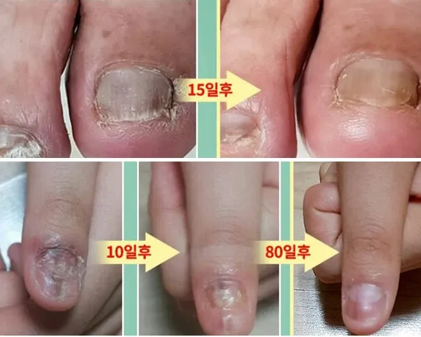 발톱무좀 없애는 방법