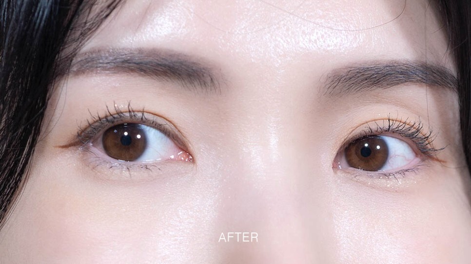 눈밑지방재배치 후기