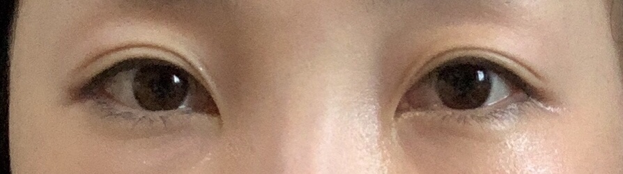 눈밑지방재배치 후기