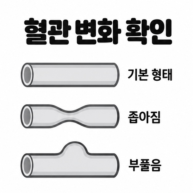 혈관 변화 확인이라는 제목 아래 기본 형태, 중간이 좁아진 형태, 한쪽이 둥글게 부푼 형태의 혈관 모식도 세 개를 비교한 그림