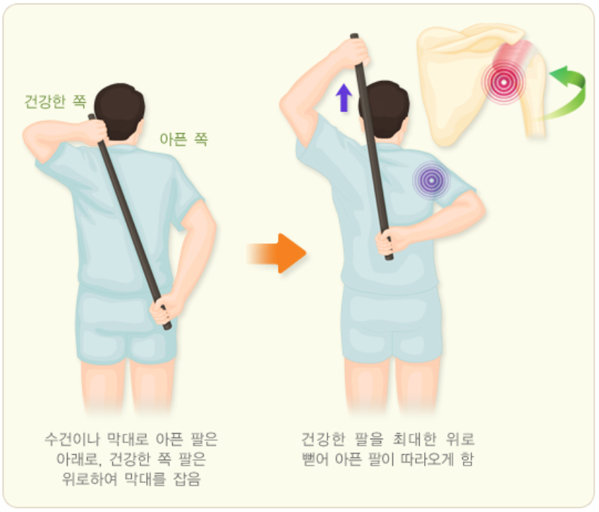 오십견 치료 운동법