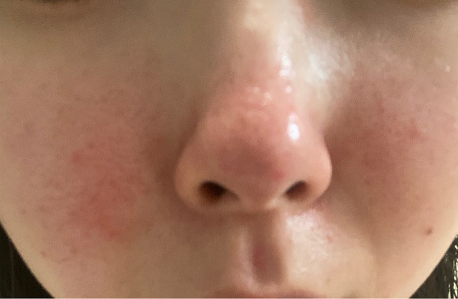 코와 코의 옆 피부가 붉게 변하는 비사증을 앓고 있는 환자의 환부를 확대를 하여 찍은 사진