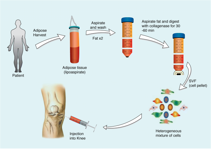 자가지방기질혈관분획주사