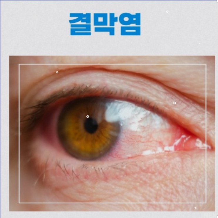 결막염