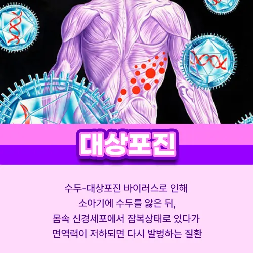 대상포진 진료과