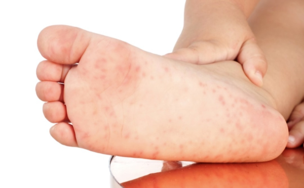 수족구에 대해서 알아보자.