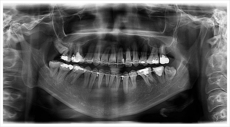양악수술전(정면)