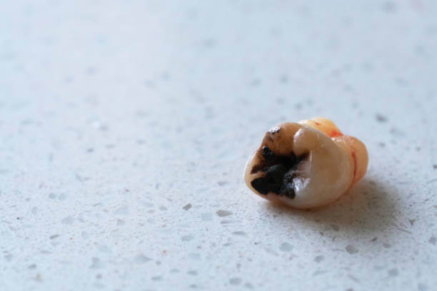 사랑니 발치 후 식사, 드라이 소켓이 생기는 이유에 대해 알아봤습니다. 사랑니 위치와 발치를 한 후에 조심해야 할 사항들, 사랑니를 발치하지 않으면 생기는 질병까지 꼼꼼히 읽어 보시기 바랍니다.