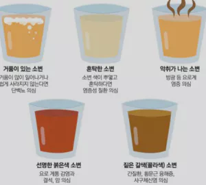 소변거품-사진2
