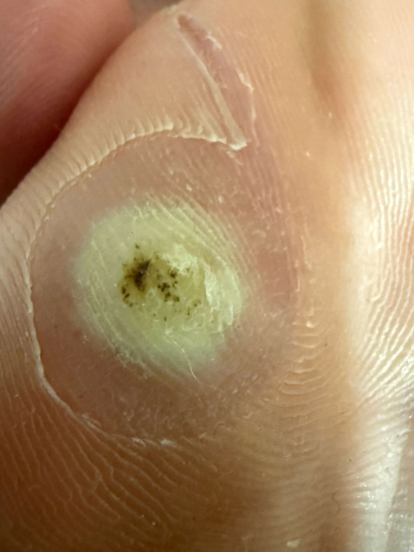 족저사마귀-자가치료-5일차-사진