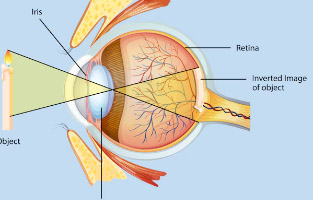 안구건조증의 증상과 치료