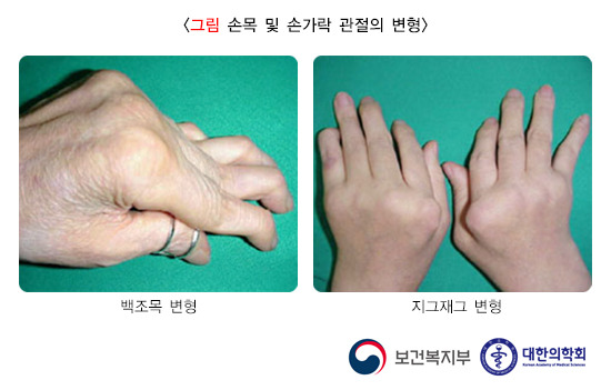 손가락 류마티스 관절염 주요 증상과 체크 리스트