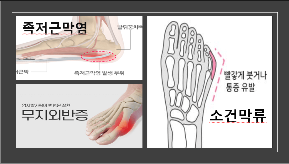 족부질환 집중조명