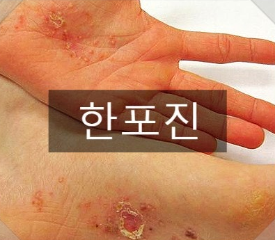 한포진 원인 증상 연고 치료 한포진전염