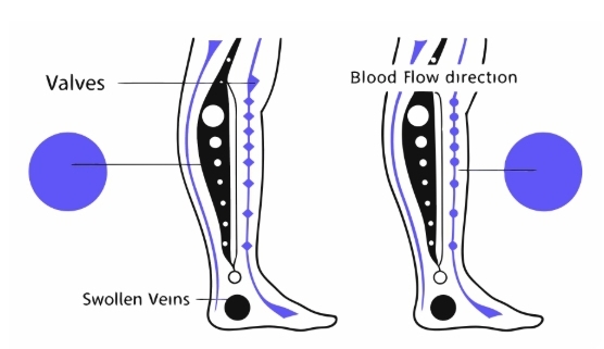 하지정맥류 원인과 의심증상