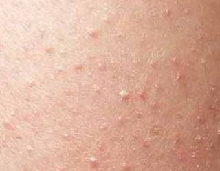 모공각화증 증상