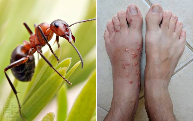 붉은독개미 물린자국 구별,건강