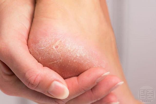 발이 보내는 위험한 신호 발 가렵고 벗겨짐 무좀