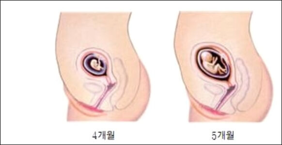 왼쪽 아랫배 통증 원인과 치료법