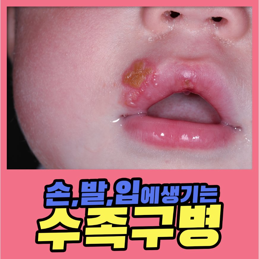 수족구 증상과 격리기간, 보험금 30만원 지급받는 방법