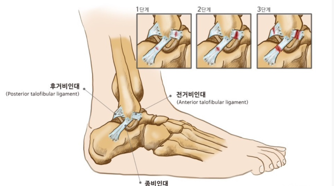 발목 인대의 구조와 염좌의 3단계