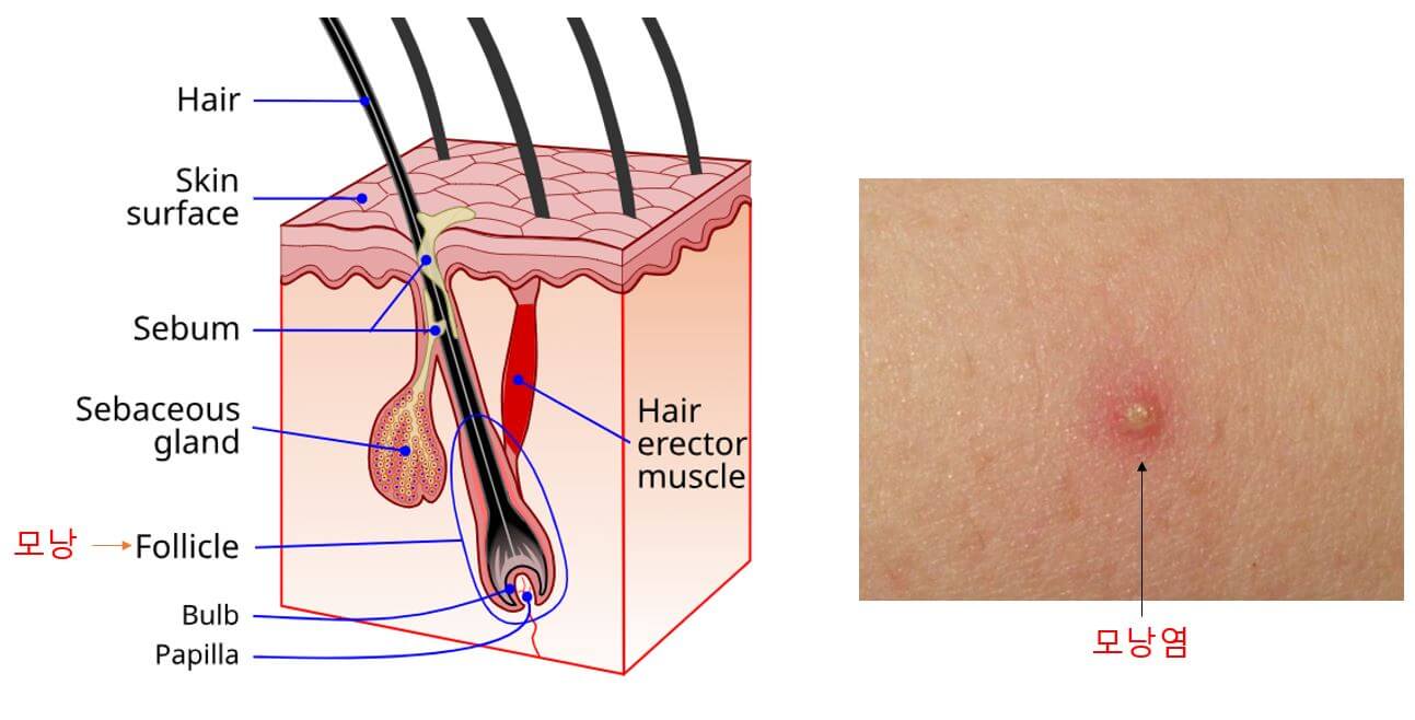 모낭위치-모낭염-피부발진